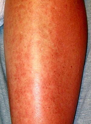 Urticaria 2
