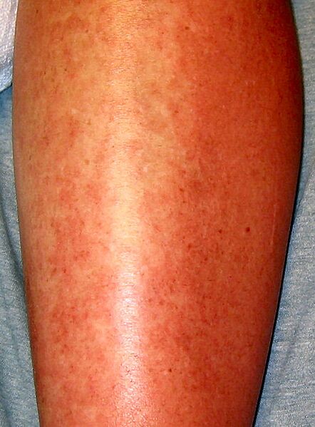 Urticaria 2