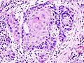 Oral cancer (1) squamous cell carcinoma histopathology