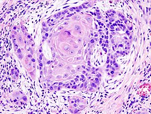 Oral cancer (1) squamous cell carcinoma histopathology