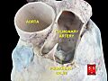 Pulmonary artery