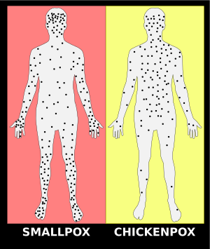 Smallpox versus chickenpox english plain