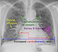 Chest radiograph with signs of congestive heart failure - annotated