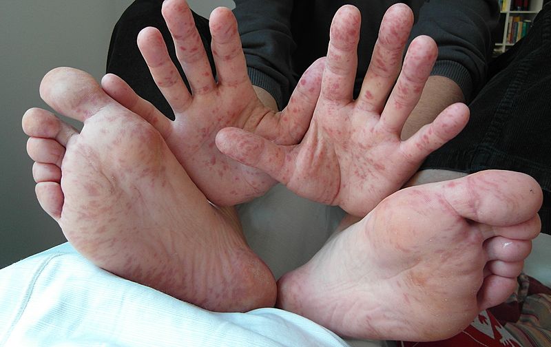 Hand Foot Mouth Disease Adult 36Years