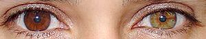 Heterochromia