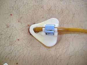 Percutaneous endoscopic gastrostomy-tube