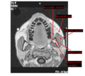 MRI showing masseter muscle and neighbors