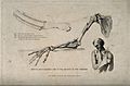 Diagrams illustrating how to set a broken arm. Stipple engra Wellcome V0016831
