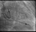 Fluoroscopy pacemaker leads right atrium ventricle