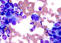 Melanoma - cytology field stain