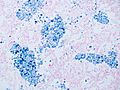 Intra-alveolar hemosiderin deposition - Prussian blue stain