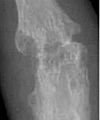 X-ray of right fourth PIP joint with bone erosions by rheumatoid arthritis