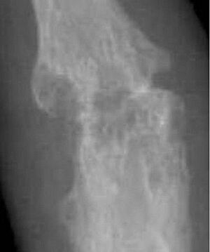 X-ray of right fourth PIP joint with bone erosions by rheumatoid arthritis