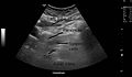 Pancreas ultrasound normal