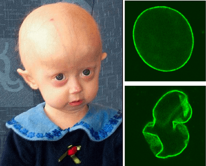 Hutchinson-Gilford progeria syndroom.png