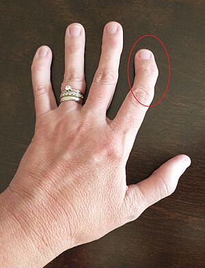 Osteoarthritis in the left hand index finger