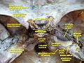 Occipital bone dissection