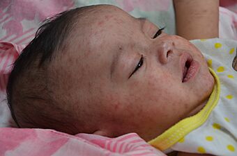 Measles child Philippines