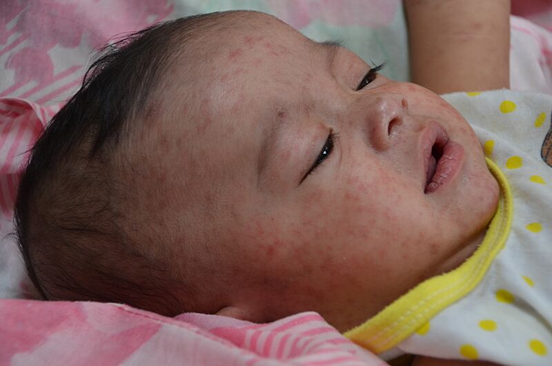 Measles child Philippines