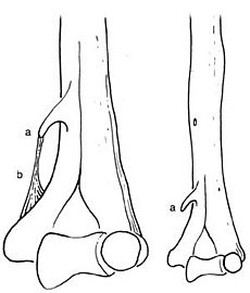 Ligament of Struthers 1854