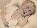 Child with measles modified by cyanosis Wellcome L0061496