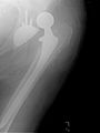 Dislocated hip replacement
