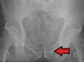 Brachytherapybeads