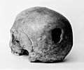 Edinburgh Skull, trepanning showing hole in back of skull Wellcome M0009393