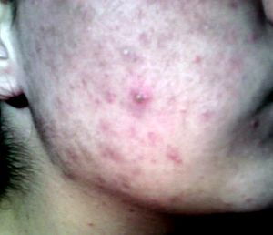 Teenager-with-acne