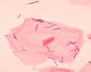 "Lactobacillus" sp. near a squamous epithelial cell
