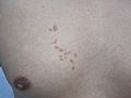 Photography of sebaceous hyperplasia