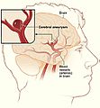 Cerebral aneurysm NIH