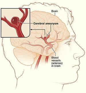 Cerebral aneurysm NIH