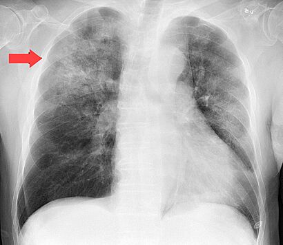 Chest radiograph in influensa and H influenzae, posteroanterior, annotated.jpg
