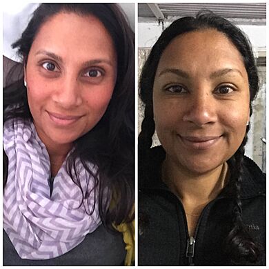 Peripheral edema of a woman's face, before and after; Annapurna Base Camp, 2015