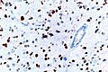 Anaplastic astrocytoma - p53 - very high mag