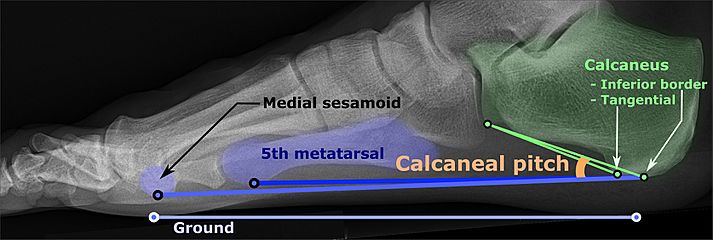 Calcaneal pitch