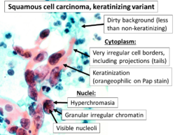 Cytopathology of keratinizing squamous cell carcinoma