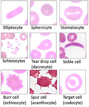 Poikilocytes - Red blood cell types