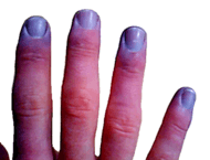Cyanosis-adult fingertips.PNG