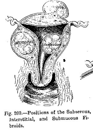 Fibroids