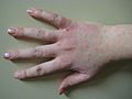 Human hand with dermatitis