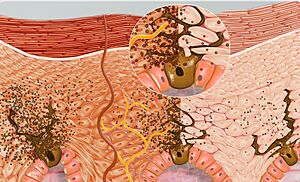 Melanin production as a result of tanning