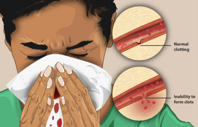 A woman suffering from Hemophilia