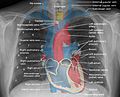 Mediastinal structures on chest X-ray, annotated