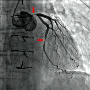 Angiography coronary stenosis 01