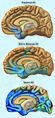Alzheimer’s Disease, Spreads through the Brain (24524716351)