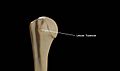 Lesser-Tubercle-of-Right-Humerus