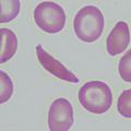 Red Blood Cells in Sickle Cell Disease