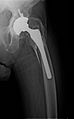 Periprosthetic fracture of left femur, case 1, before treatment
